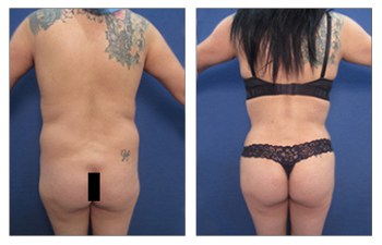 Buttock Augmentation