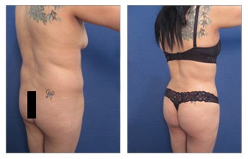 Buttock Augmentation Enhancement Risks Rancho Mirage CA Dr 90210 Plastic  Surgery