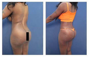 Ultimate Brazilian Butt Lift for Athletic Women - Dr. Laguna