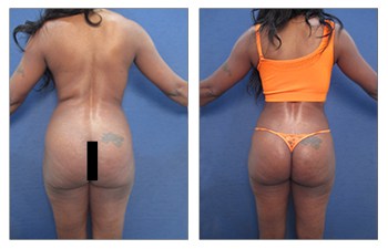 Butt Implant Alternative, Our Surgical Team