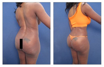 Differences Between Fat Transfer And Implants For A Butt Lift