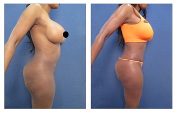 Butt Augmentation Los Angeles - Butt Implants - Gluteal Implant