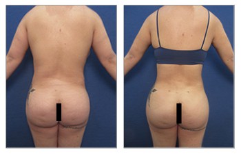 Brazilian Buttocks Lift (BBL)