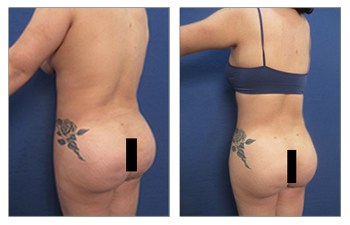 Free BBL with lipo 360, Our Surgical Team