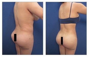 Should you get your BBL in Omaha or Miami? Omaha Liposuction