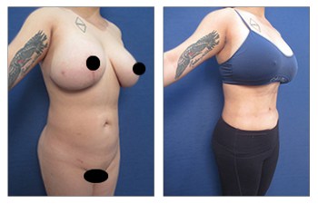 Free BBL with lipo 360, Our Surgical Team