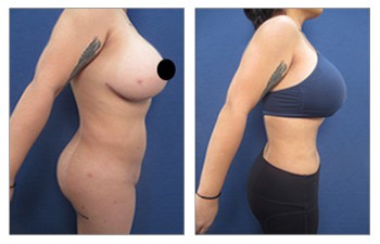 Should you get your BBL in Omaha or Miami? Omaha Liposuction