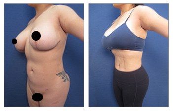 Free BBL with lipo 360, Our Surgical Team