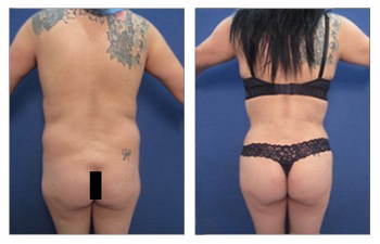 Liposuction 360