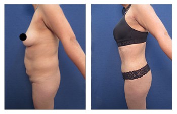 Lipo 360 Transforms & Slims Your Waistline