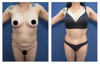 Understanding High-Definition Liposuction: Advanced Plastic Surgery Center:  Plastic and Reconstructive Surgeons