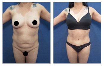 Tummy Tuck surgery or abdominoplasty in skilled hands is amazing