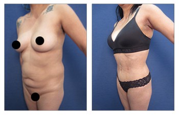 How to Get an Innie Belly Button with a Tummy Tuck