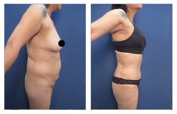 High definition liposuction Beverly Hills