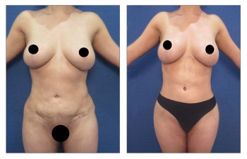 Painless Lipo