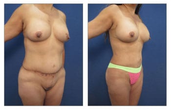 High Definition Liposuction Revision