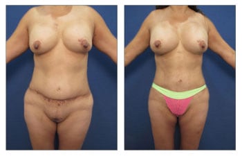 Renuvion Before and After - Body Lift with Tummy Tuck