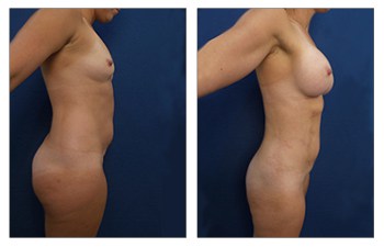 Skin Tightening