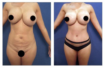High Definition Liposuction Revision
