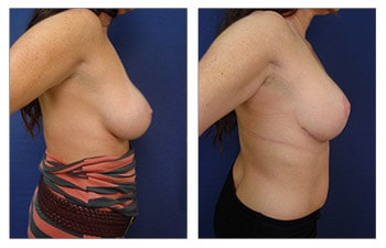 BREAST AUGMENTATION UPDATE, BREAST LIFT & BREAST IMPLANTS, 1.5 YEAR POST  OP UPDATE