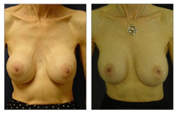 Breast Augmentation Surgery