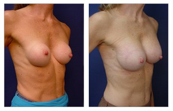 ideal breast implant size Beverly Hills