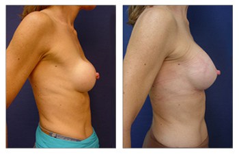 breast asymmetry Beverly Hills - Capsular Contracture and Asymmetry