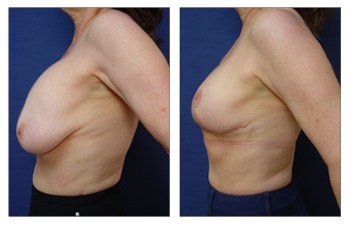 Breast Augmentation Revision in Beverly Hills