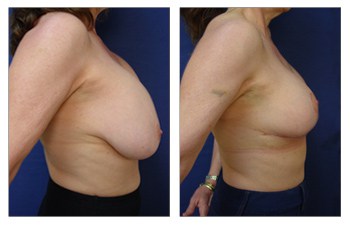 Correcting Male Breast Asymmetry Beverly Hills