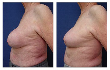 Breast Augmentation Revision – Patient 315