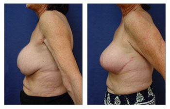 🥇 Bad Boob Job? When to Consider Breast Implant Revision