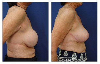 Breast Augmentation Revision Surgery Recovery