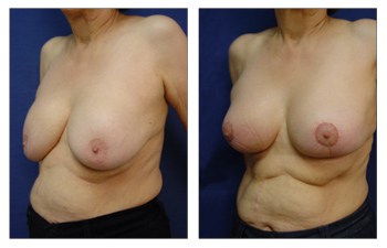 Breast Augmentation Revision To Correct A Snoopy Deformity