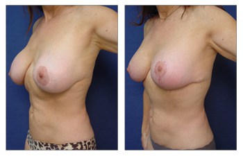 Breast Augmentation Revision Of Aged Breast Implant