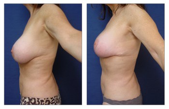 Ideal breast appearance Laguna Beach