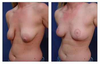 Breast Lift Newport Beach