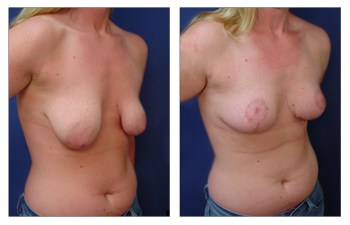 Is Breast Lift Safe