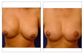 Breast Enhancement San Diego - Correct Nipple Position Asymmetry procedure