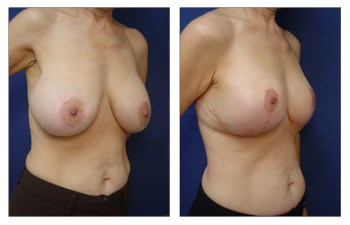 right front oblique Breast Lift With Implant Augmentation To Decrease Areola Size