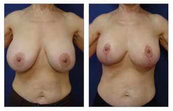 front view Breast Lift With Implant Augmentation To Decrease Areola Size