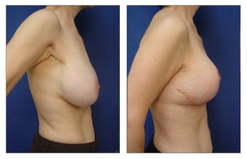 right view Breast Lift With Implant Augmentation To Decrease Areola Size