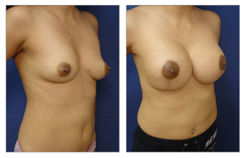 right front oblique Breast Lift With Implant Augmentation Southern California