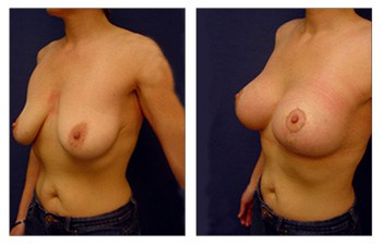 Breast Lift With Implant Augmentation Limitations