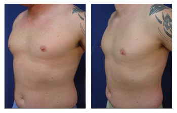 Gynecomastia Causes