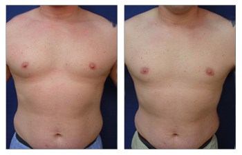 Gynecomastia Causes