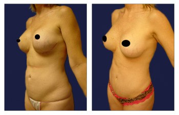 Tummy Tuck Newport Beach