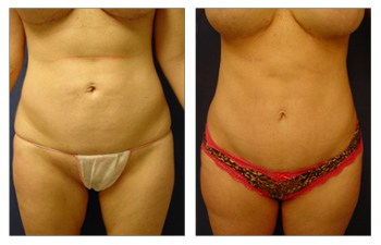 Is Muscle Repair with Tummy Tuck Always Necessary? - Power Plastic