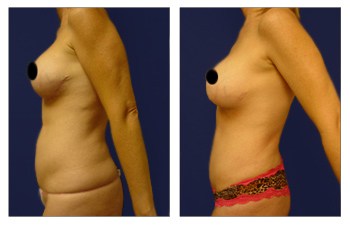 Does Mini Tummy Tuck Tighten Muscles