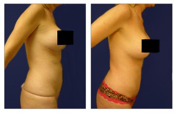 Does Mini Tummy Tuck Tighten Muscles