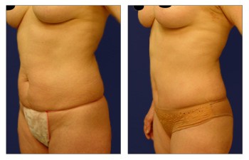 How Much Does Mini Tummy Tuck Cost